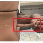 लखनऊ: बच्चे की कमर के पास निकली पूंछ, उम्र के साथ बढ़ती गई लंबाई..