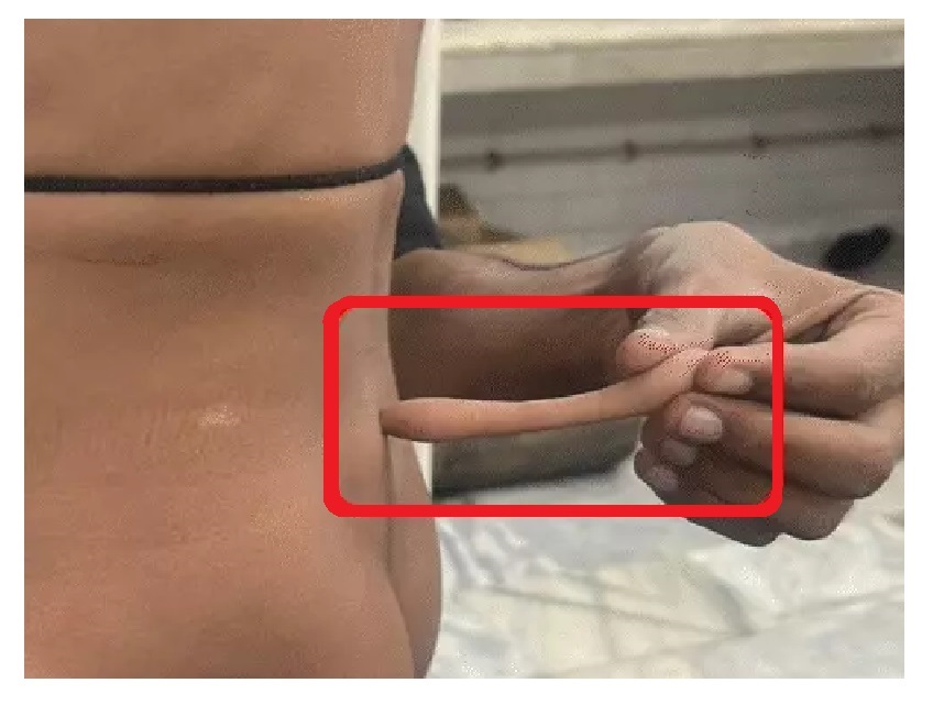 Lucknow: Doctors surgically removed child's tail from his waist 